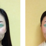 kyousei 180x180 - 【頬こけが原因】老け顔を治す予防法
