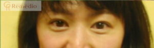 image 300x95 - 目のくぼみ、眼瞼下垂の原因