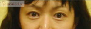 image1 300x97 - 目のくぼみ、眼瞼下垂の原因