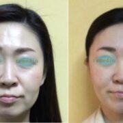 歯列矯正 顔の変化 180x180 - 目のくぼみ、眼瞼下垂の原因