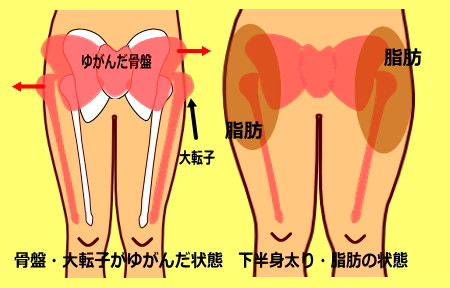 骨盤の横幅が広い 大転子が出っ張っている人の特徴 中目黒整体レメディオ