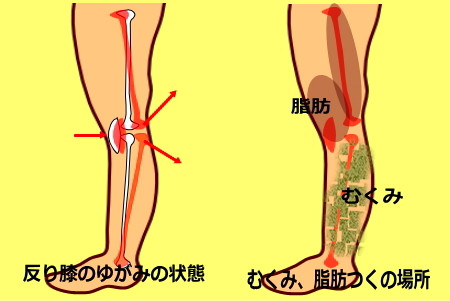 sorihia mukumi 1 - 反り膝による前もも太り　膝の上のお肉