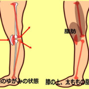 sorihiza hizaue 1 1 180x180 - 反り膝による前もも太り　膝の上のお肉