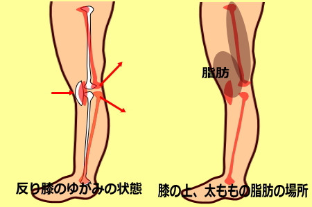 sorihiza hizaue 1 1 - 反り膝による前もも太り　膝の上のお肉