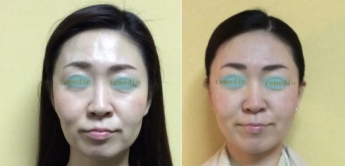 頬こけが原因 老け顔を治す予防法 中目黒整体レメディオ