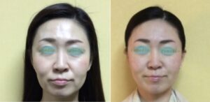 頬のコケ 300x146 - 【頬こけが原因】老け顔を治す予防法