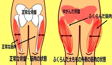 hutomomosotogawa 1 450x262 - 太ももを太くさせるゆがみの原因