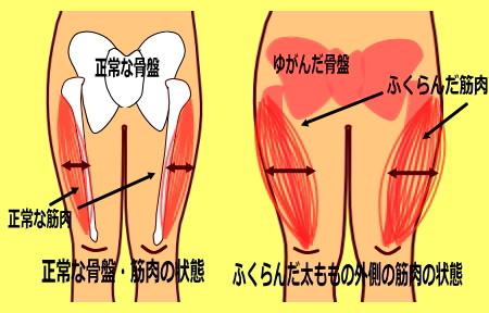 hutomomosotogawa 1 - 膝下О脚　腓骨の出っ張りの原因