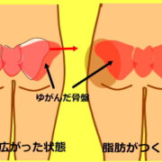 o0450029013620194861 1 180x180 - 骨盤のゆがみの原因
