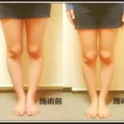 o0450036013617510997 180x180 - 骨盤のゆがみの原因