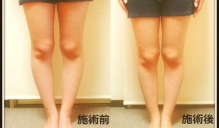 o0450036013617510997 450x262 - 膝下О脚　腓骨の出っ張りの原因